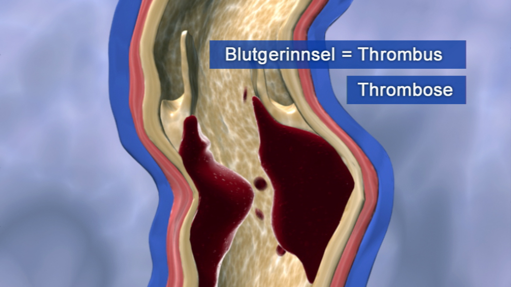 Diagramm, das einen Blutgerinnsel (Thrombus) in einem Blutgefäß zeigt, mit den Begriffen 'Blutgerinnsel' und 'Thrombose' beschriftet.