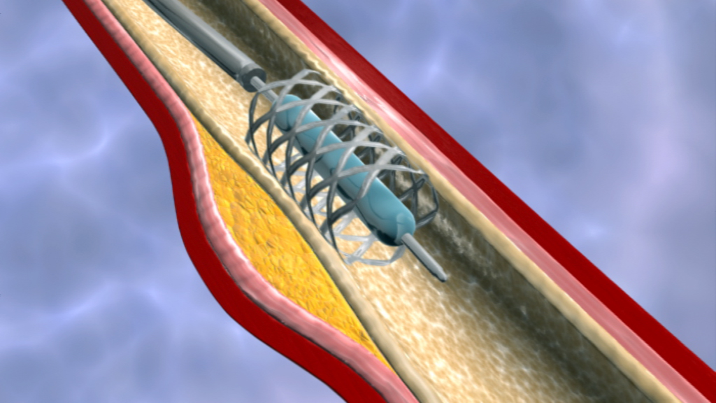 3D-Darstellung eines Stents in einer Arterie, umgeben von Fettablagerungen.