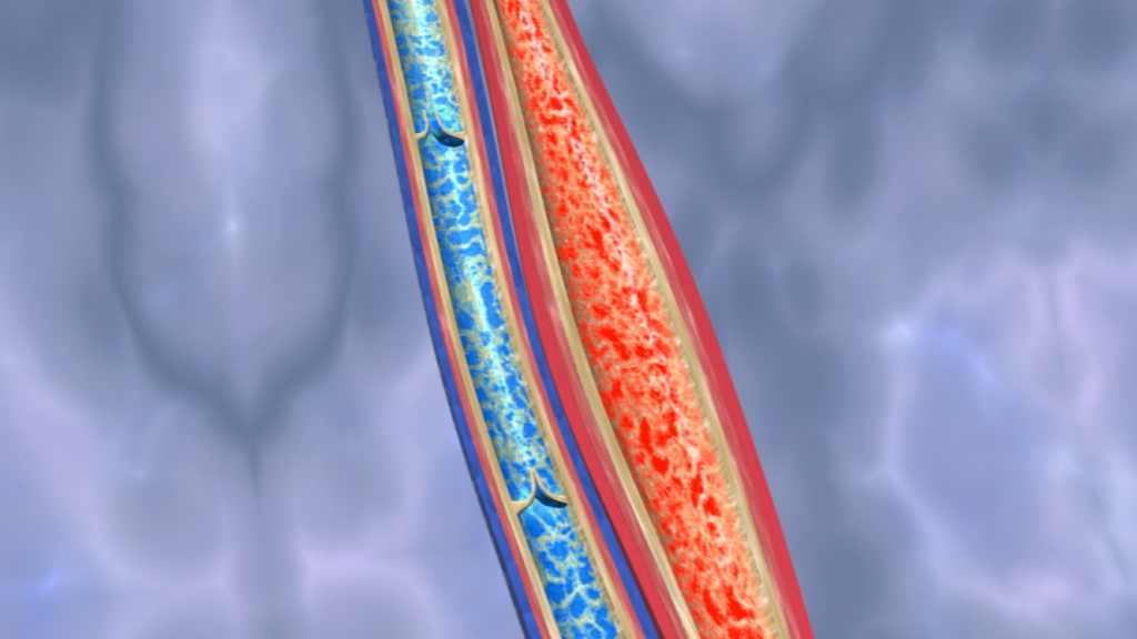 Grafik, die den Querschnitt einer Arterie zeigt, mit blauen und roten Bereichen, die unterschiedliche Gewebe darstellen.