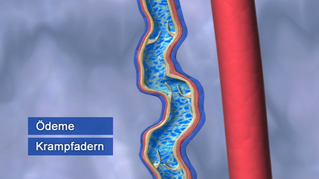 Grafik, die Ödeme und Krampfadern in einem Blutgefäß darstellt, mit blauer Flüssigkeit und gewellter Form.