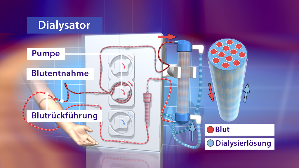 Diagramm eines Dialysators mit Beschriftungen für Pumpe, Blutentnahme, Blutückführung und Dialysierlösung.