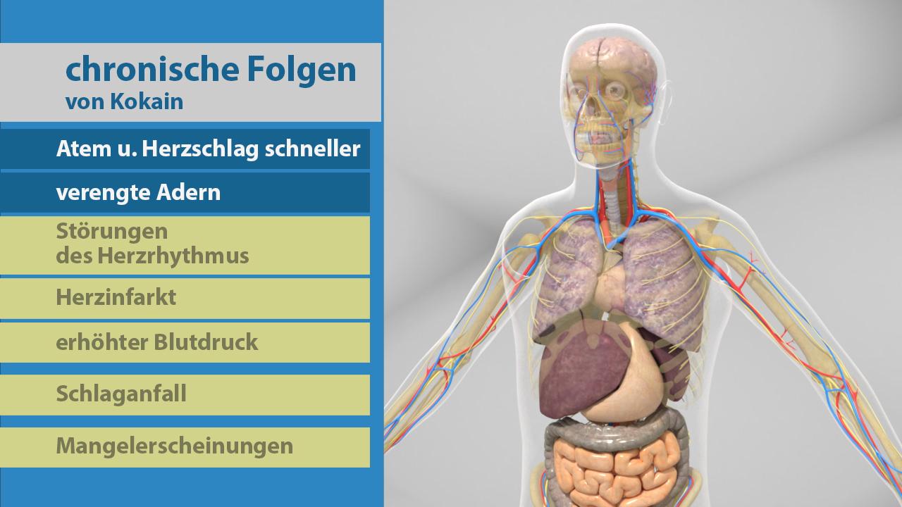 Infografik über die chronischen Folgen von Kokain, einschließlich schnellerer Atmung und Herzschlag, verengter Adern, Herzrhythmusstörungen, Herzinfarkt, erhöhtem Blutdruck, Schlaganfall und Mangelerscheinungen.
