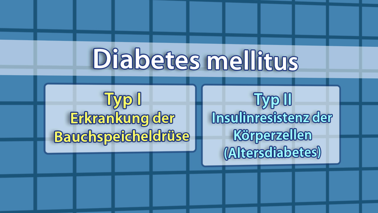 Infografik über Diabetes mellitus mit zwei Typen: Typ I - Erkrankung der Bauchspeicheldrüse, Typ II - Insulinresistenz der Körperzellen (Altersdiabetes).