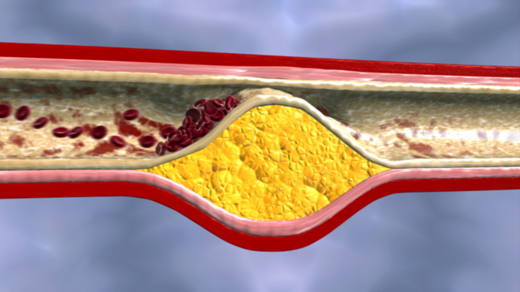 Grafik eines verengten Blutgefäßes mit Ablagerungen von Fett und Cholesterin.