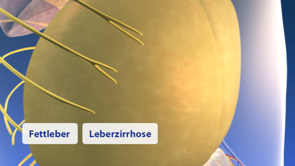 3D-Darstellung der Leber mit Beschriftungen 'Fettleber' und 'Leberzirrhose'.