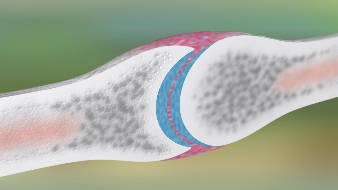 Grafik eines Gelenks, das die Verbindung zwischen zwei Knochen zeigt, mit blauen und roten Bereichen, die die Gelenkflüssigkeit und das Knorpelgewebe darstellen.