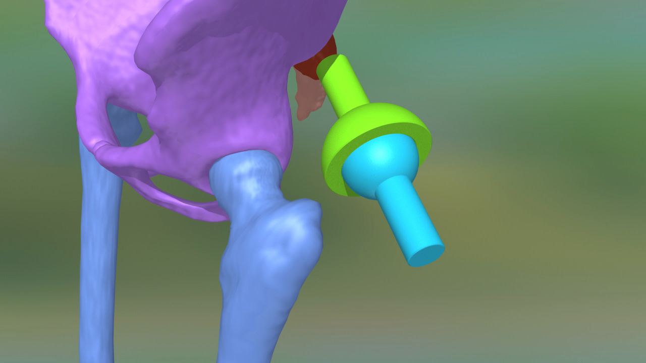 3D-Modell eines Oberschenkelknochens mit einer farbigen Prothese.
